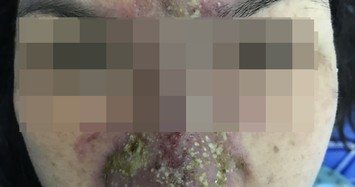 Bệnh viện Mắt TP HCM cấp cứu nhiều ca tổn thương mắt do làm đẹp ở cơ sở chui