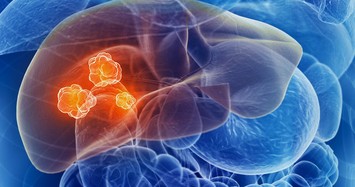 3 loại nguyên liệu làm tổn thương gan, nuôi tế bào ung thư