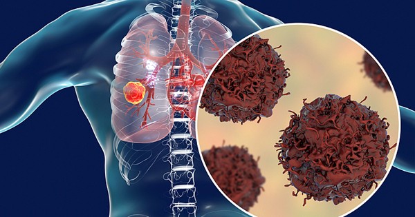 Chuyên gia chỉ cách phòng ung thư phổi từ ca thực tiễn