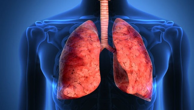 Cảnh báo dấu hiệu ở đầu là triệu chứng của ung thư phổi