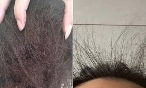 3 tháng không gội đầu vì sợ rụng tóc, cô gái nhận cái kết đắng