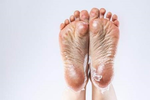 5 tín hiệu từ bàn chân cho thấy bạn cần đi khám gan ngay 
